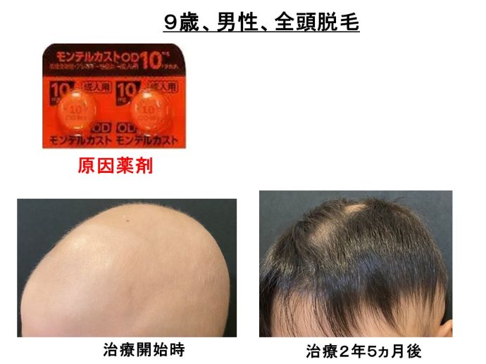 円形脱毛症　病院